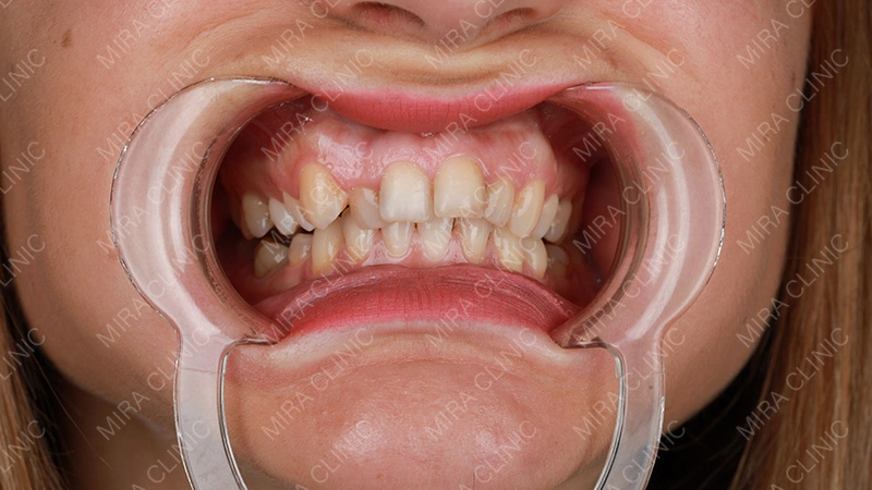 veneers before - after